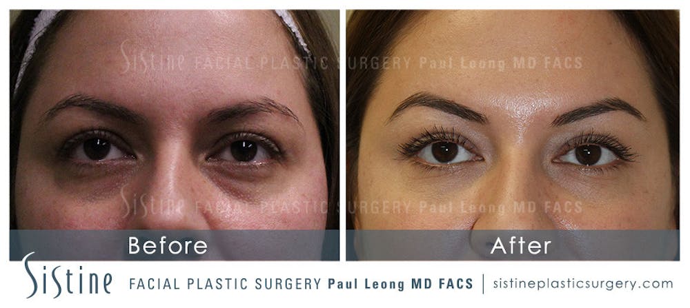 Restylane/ Juvederm Before & After Gallery - Patient 4891429 - Image 1