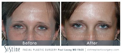 Tear Trough Correction Before & After Gallery - Patient 4891868 - Image 1