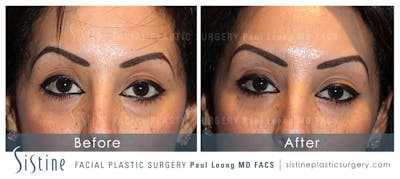 Tear Trough Correction Before & After Gallery - Patient 4891869 - Image 1