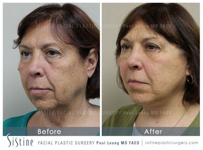 Tear Trough Correction Before & After Gallery - Patient 4892032 - Image 1