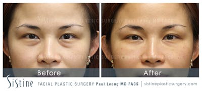 Tear Trough Correction Before & After Gallery - Patient 4892035 - Image 1
