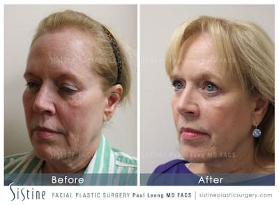 Cortex™ CO2/Erbium Yag Laser Before & After Gallery - Patient 4893417 - Image 1