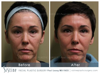 Cortex™ CO2/Erbium Yag Laser Before & After Gallery - Patient 4893486 - Image 1