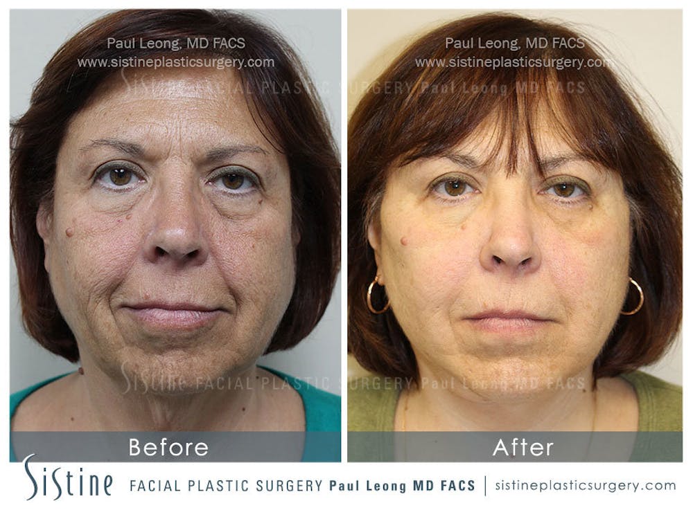 Restylane/ Juvederm Before & After Gallery - Patient 4891470 - Image 2