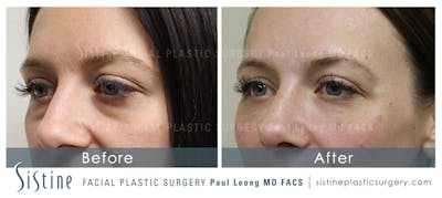 Restylane/ Juvederm Before & After Gallery - Patient 4891471 - Image 2