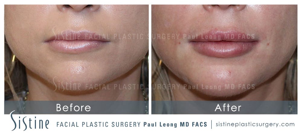 Restylane/ Juvederm Before & After Gallery - Patient 4891479 - Image 1