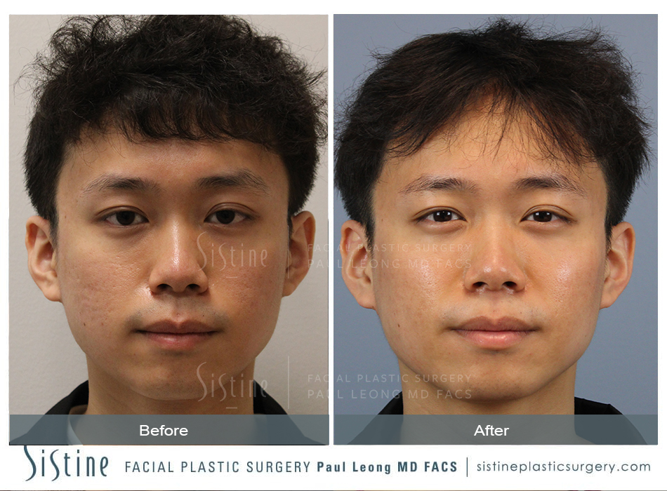 Microneedling in Pittsburgh before and after