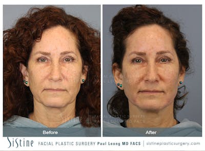 Dermal Fillers Before & After Gallery - Patient 96929187 - Image 1