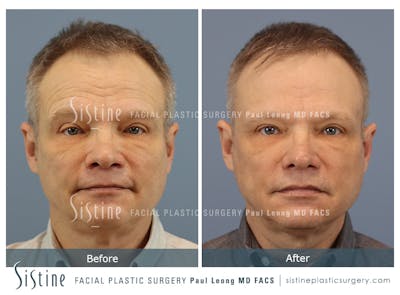 Cortex™ CO2/Erbium Yag Laser Before & After Gallery - Patient 140794460 - Image 1
