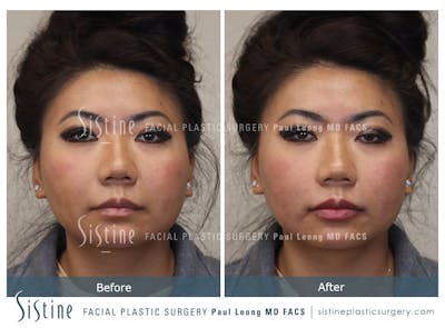 Restylane/ Juvederm Before & After Gallery - Patient 184042906 - Image 1