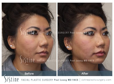Lip Augmentation Before & After Gallery - Patient 184042971 - Image 2