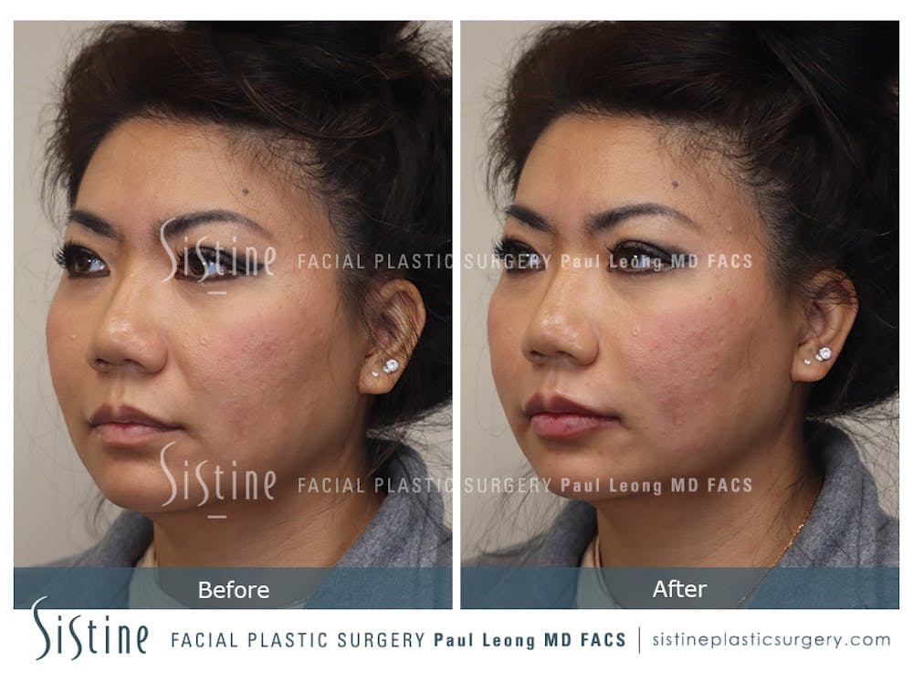 Lip Augmentation Before & After Gallery - Patient 184042971 - Image 3