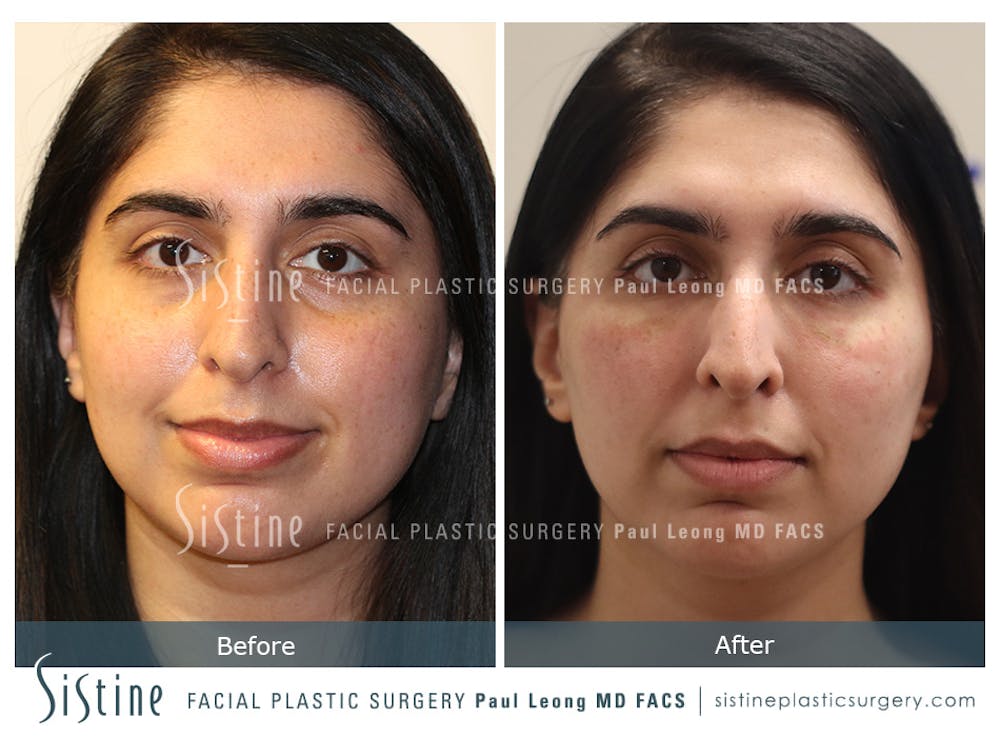 Tear Trough Correction Before & After Gallery - Patient 390631 - Image 1