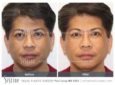 Tear Trough Correction Before & After Gallery - Patient 288110 - Image 1