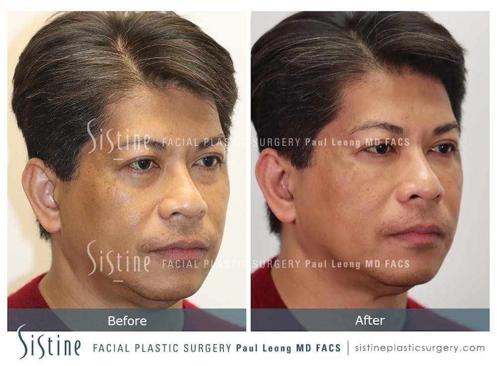 Tear Trough Correction Before & After Gallery - Patient 288110 - Image 3