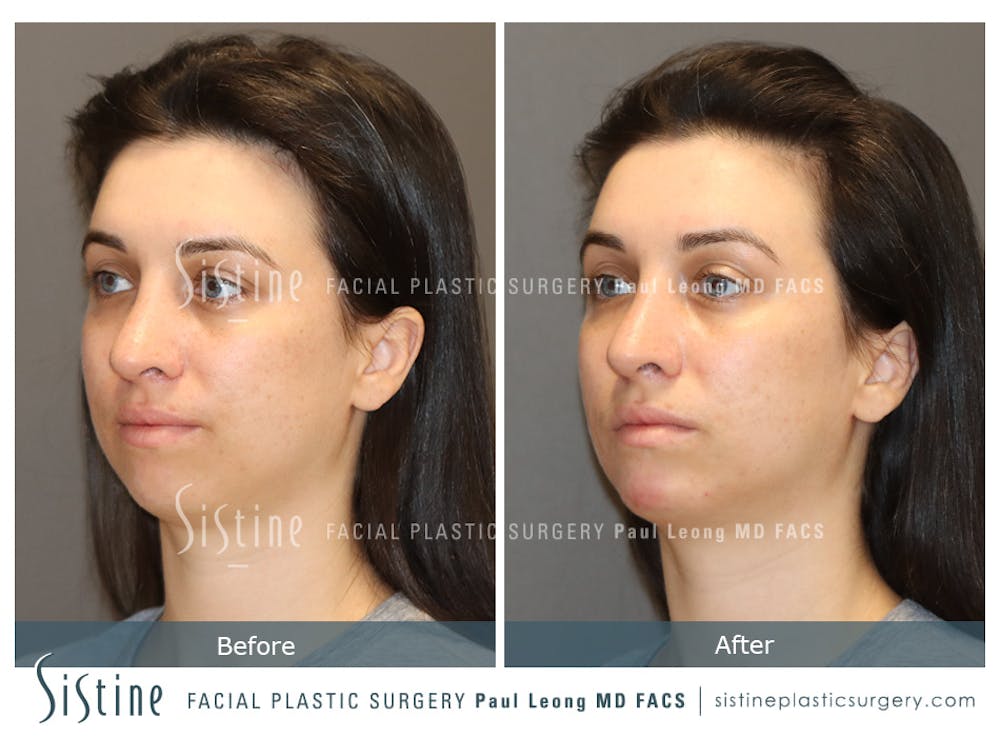 Chin, Jaw and Neck Before & After Gallery - Patient 426057 - Image 1
