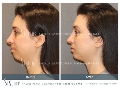 Chin, Jaw and Neck Before & After Gallery - Patient 426057 - Image 2