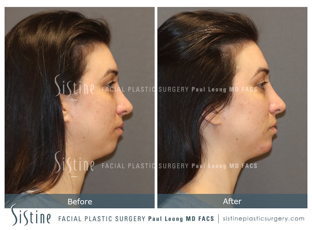 Chin, Jaw and Neck Before & After Gallery - Patient 426057 - Image 4