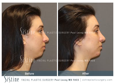 Restylane/ Juvederm Before & After Gallery - Patient 425231 - Image 4