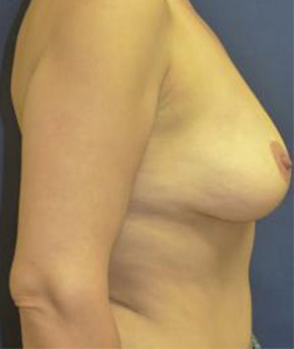 Breast Augmentation Gallery - Patient 4861023 - Image 3
