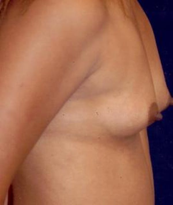 Breast Augmentation Gallery - Patient 4861024 - Image 3