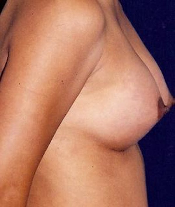 Breast Augmentation Gallery - Patient 4861024 - Image 4