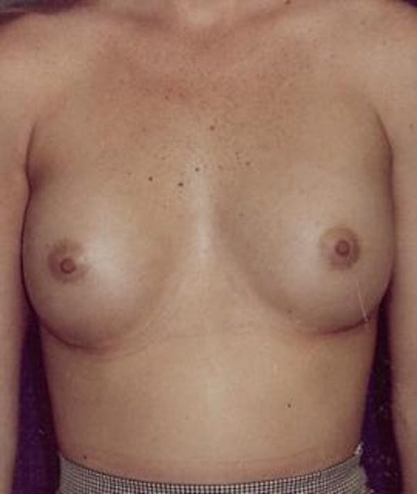 Breast Augmentation Gallery - Patient 4861029 - Image 2