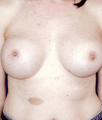 Breast Augmentation Gallery - Patient 4861034 - Image 2