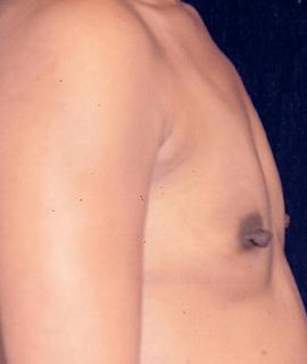 Breast Augmentation Gallery - Patient 4861035 - Image 1