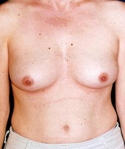 Breast Augmentation Gallery - Patient 4861036 - Image 1