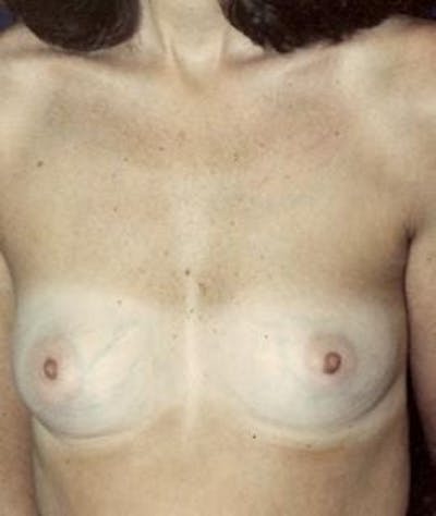 Breast Augmentation Gallery - Patient 4861037 - Image 1
