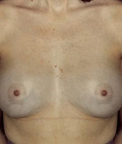Breast Augmentation Gallery - Patient 4861037 - Image 2