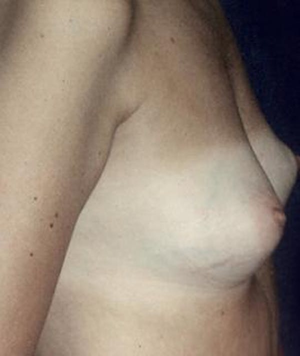 Breast Augmentation Gallery - Patient 4861037 - Image 3