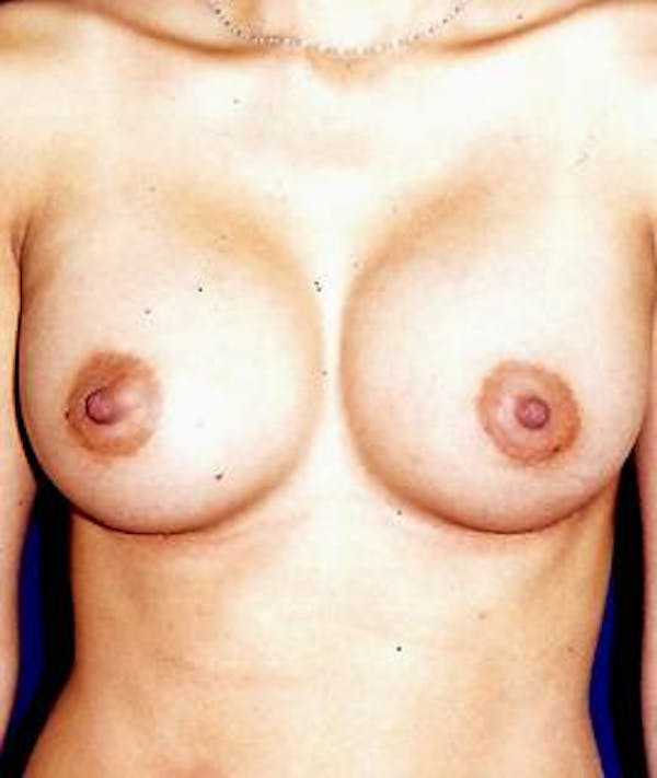 Breast Augmentation Gallery - Patient 4861039 - Image 2
