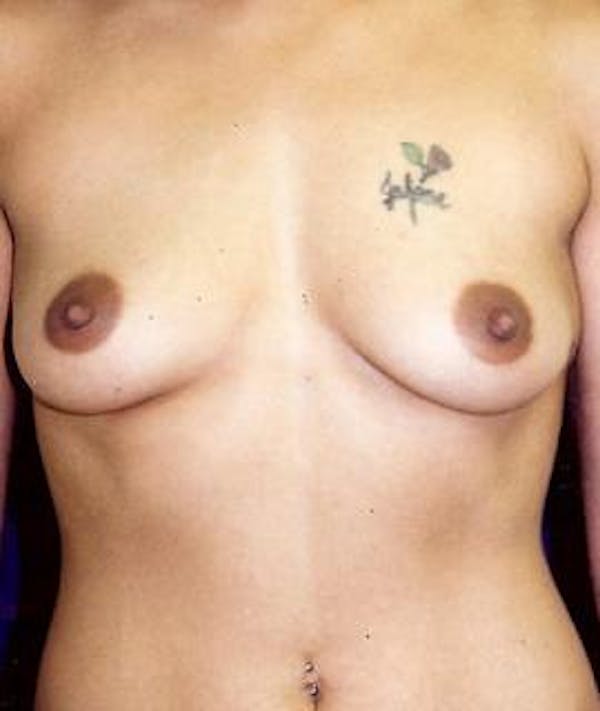 Breast Augmentation Gallery - Patient 4861042 - Image 1