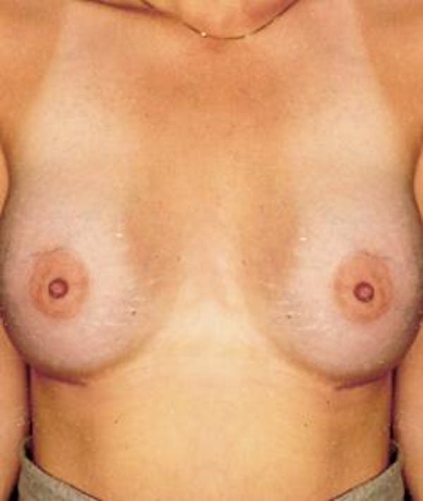 Breast Augmentation Gallery - Patient 4861044 - Image 2