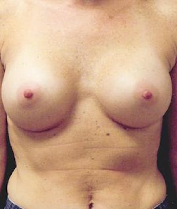 Breast Augmentation Gallery - Patient 4861045 - Image 2