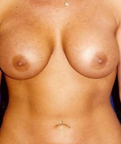 Breast Augmentation Gallery - Patient 4861048 - Image 2
