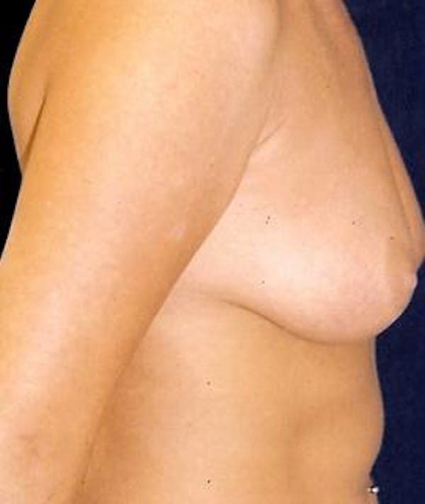 Breast Augmentation Gallery - Patient 4861048 - Image 3