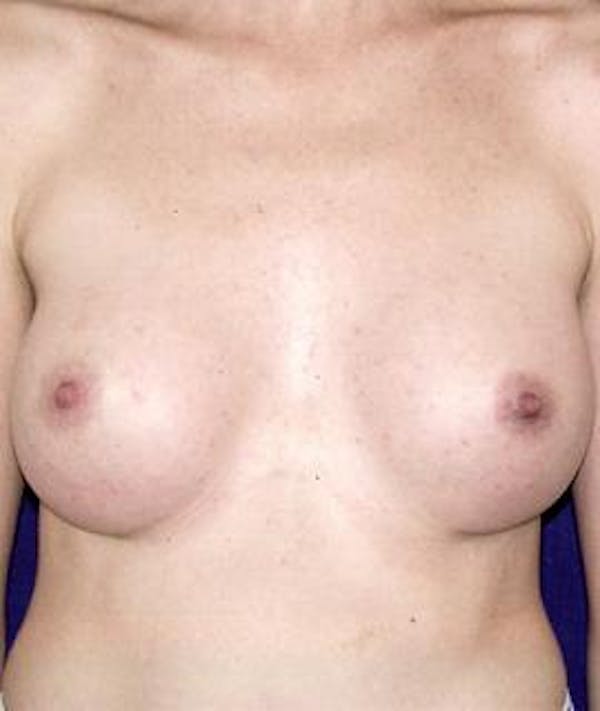 Breast Augmentation Gallery - Patient 4861052 - Image 2