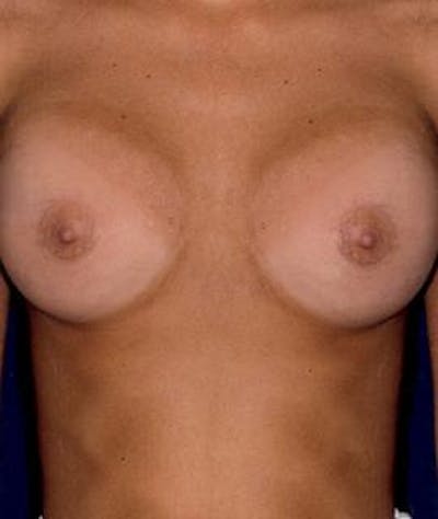 Breast Augmentation Gallery - Patient 4861053 - Image 2