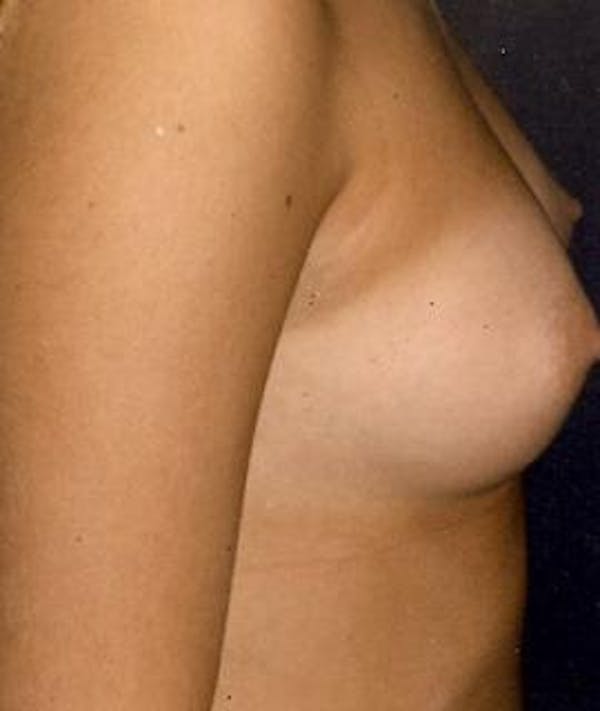 Breast Augmentation Gallery - Patient 4861053 - Image 3
