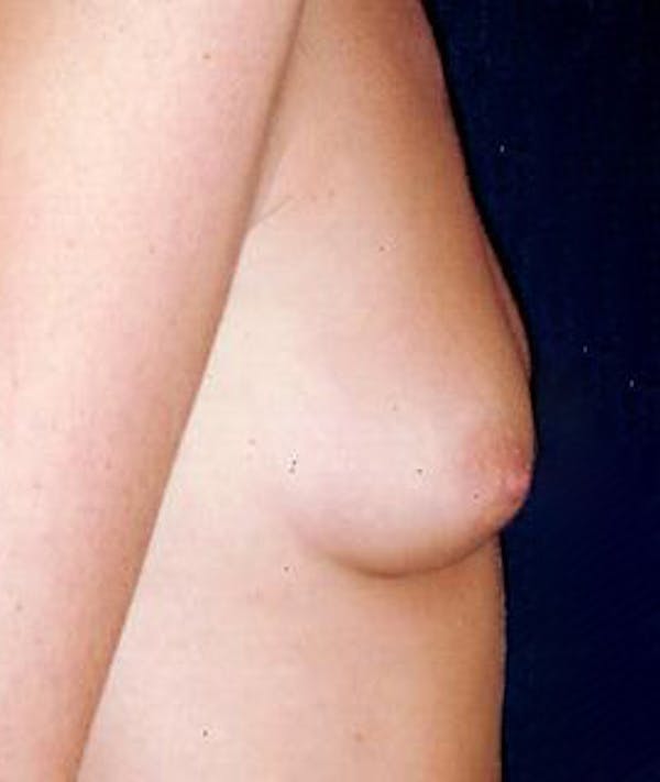 Breast Augmentation Gallery - Patient 4861055 - Image 3