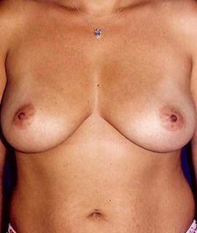 Breast Augmentation Gallery - Patient 4861059 - Image 1