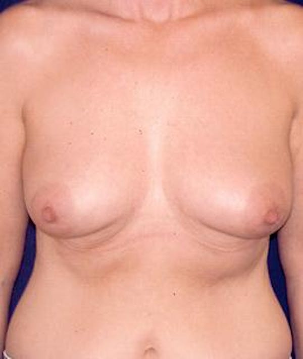 Breast Augmentation Gallery - Patient 4861067 - Image 1
