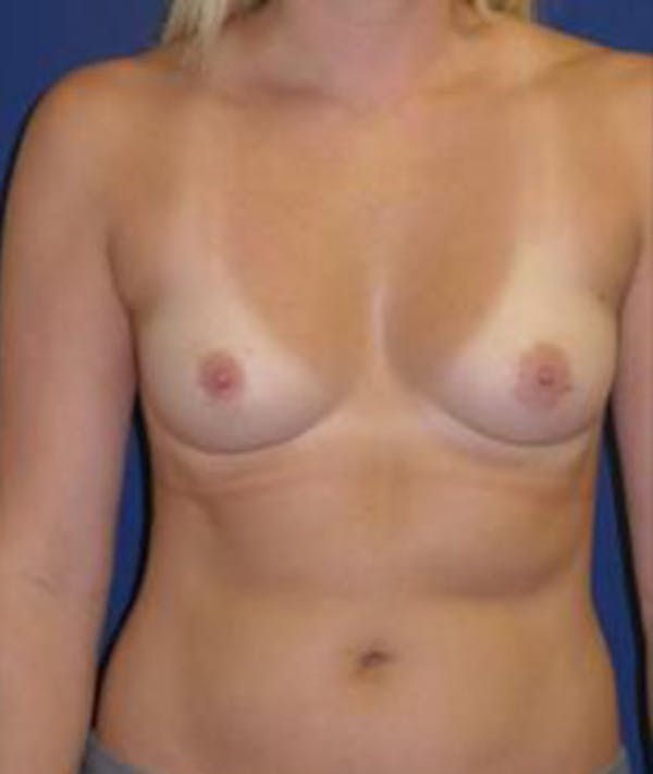 Breast Augmentation Gallery - Patient 4861077 - Image 1