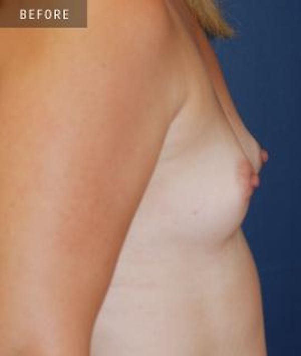 Breast Augmentation Gallery - Patient 4861079 - Image 3