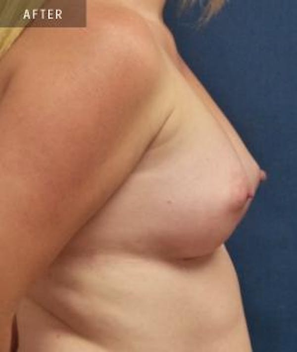 Breast Augmentation Gallery - Patient 4861079 - Image 4