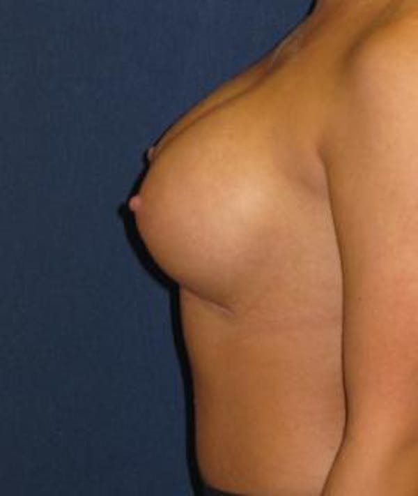 Breast Augmentation Gallery - Patient 4861081 - Image 4