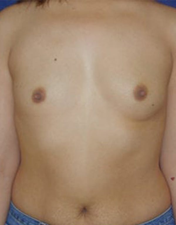 Breast Augmentation Gallery - Patient 4861085 - Image 1